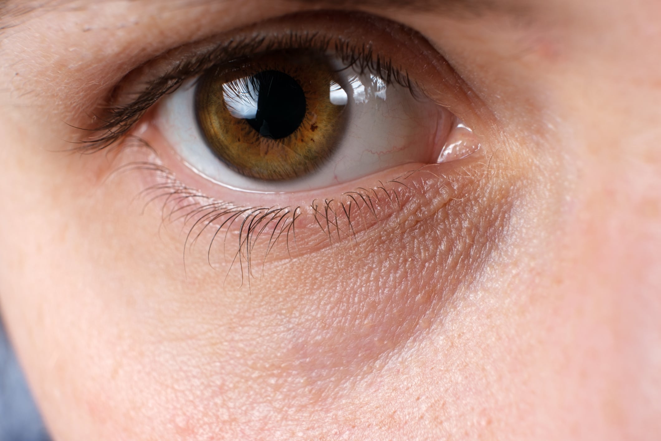 las ojeras pronunciadas son uno de los síntomas de la "cara de ferritina".