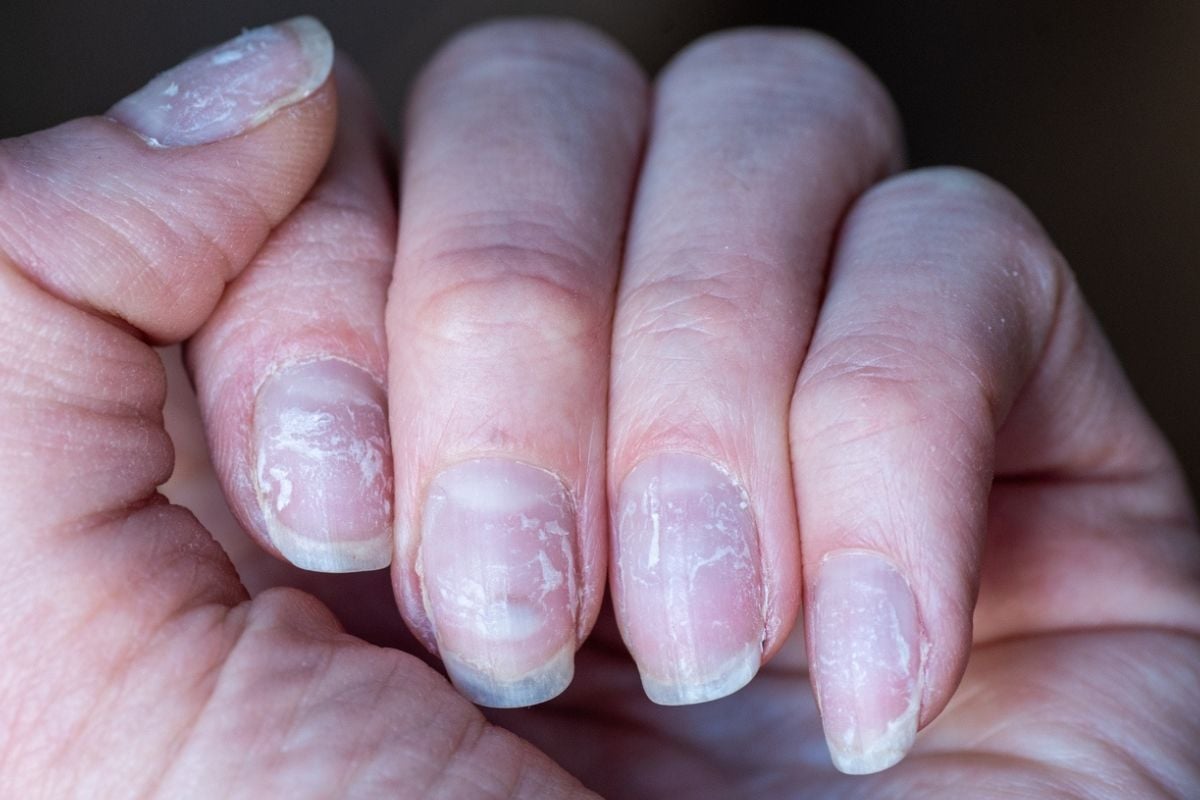 Goodbye Peeling Nails